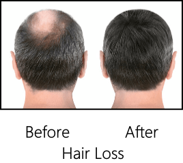 hair loss before after